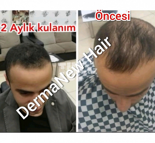 Dermanew hair saç serumu 32 AZN Tut.az Бесплатные Объявления в Баку, Азербайджане