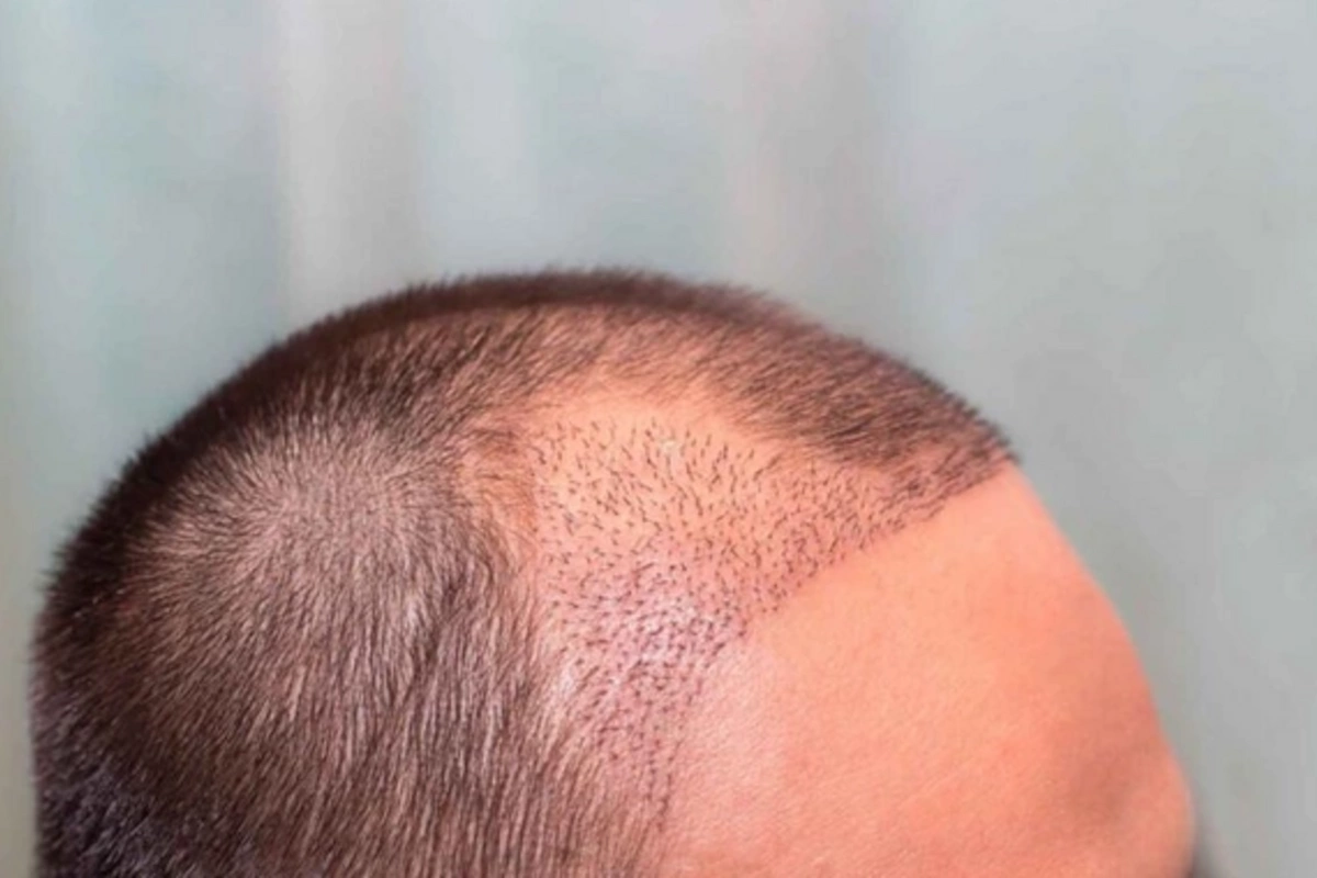 Hidden dangers of hair transplantation: who should avoid the procedure## Formatting note: Ive maintained the original text structure while translating from Russian to English as requested.