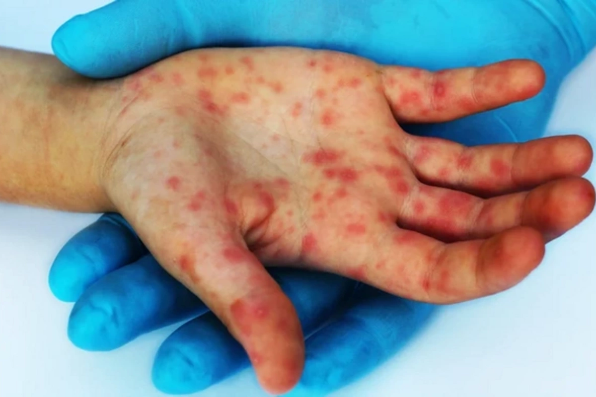First case of new monkeypox strain recorded in Australia