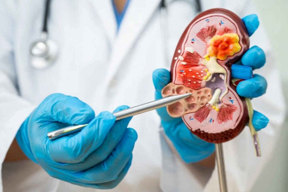 Products that protect against kidney stone formation named