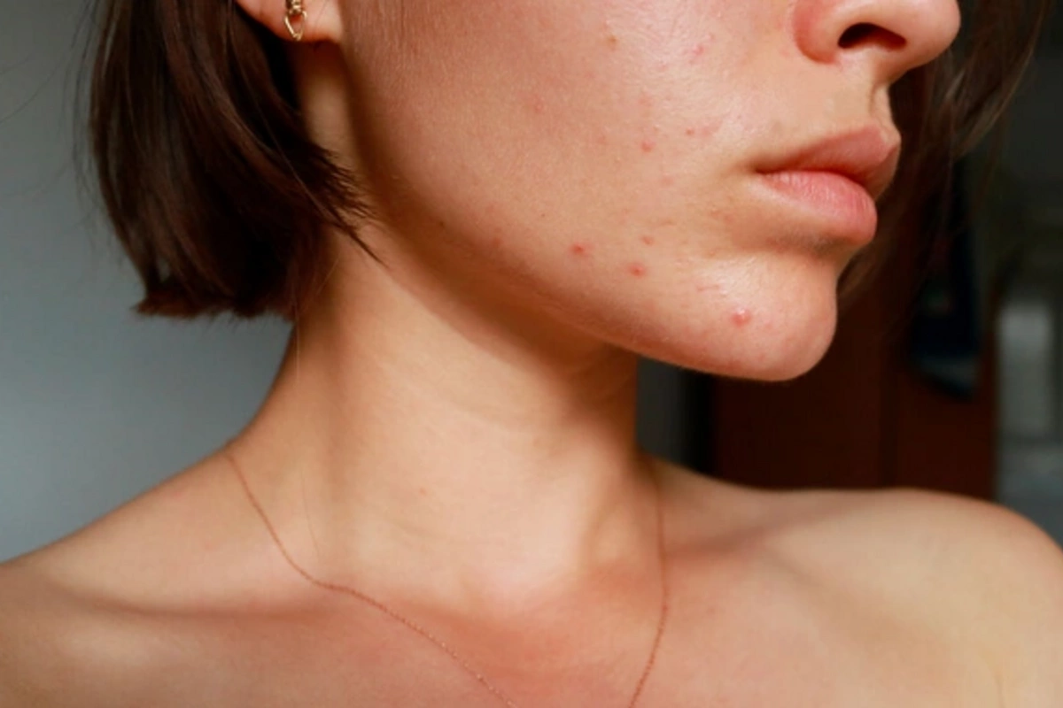 In Vietnam, a female student died after popping pimples