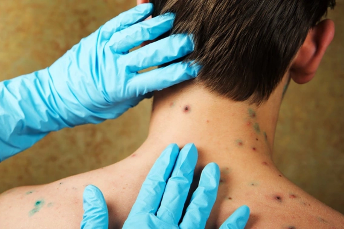 Врач рассказала, можно ли заболеть ветрянкой во второй разСпециалист в области медицины раскрыла интересные факты о повторном заражении ветряной оспой. Этот вопрос волнует многих родителей и взрослых, которые уже перенесли данное заболевание в детстве.По