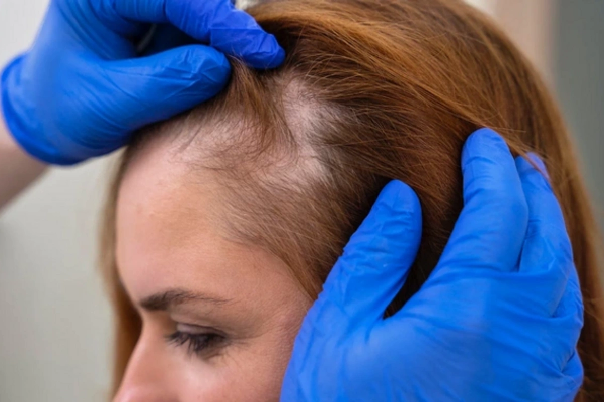 Natural solution for hormonal hair loss found