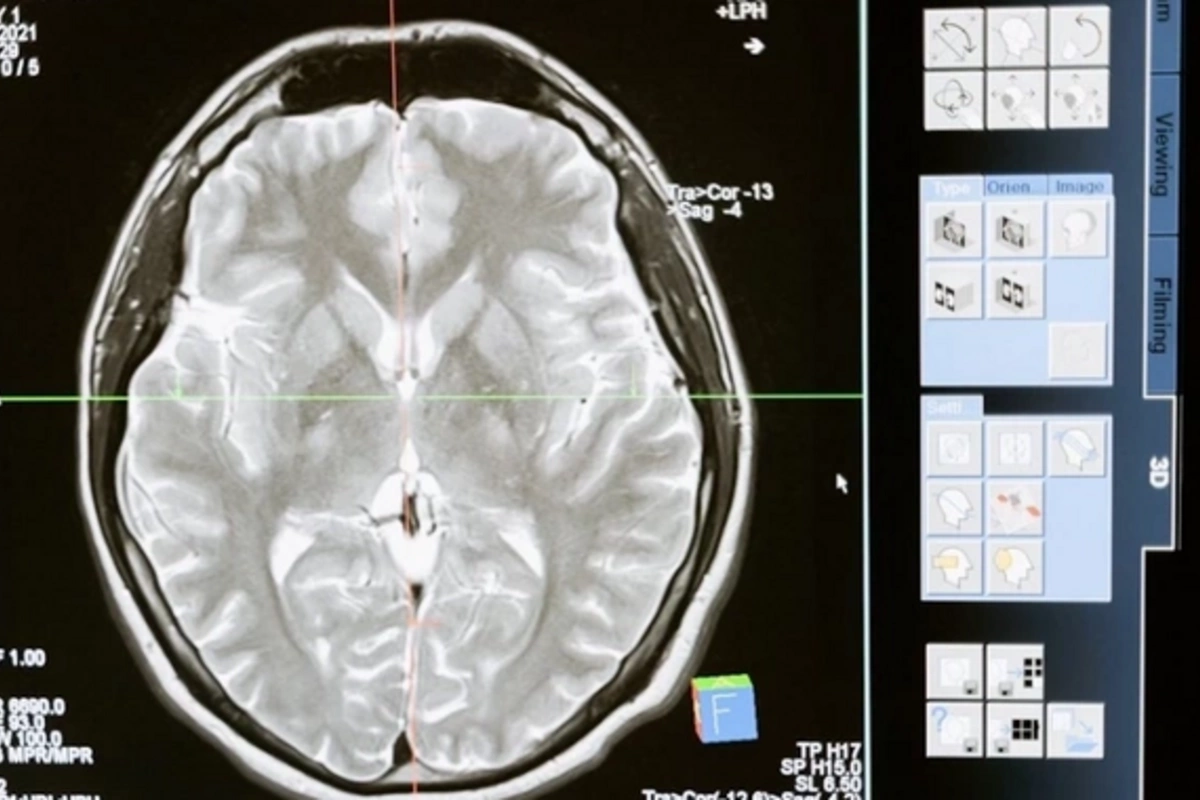 Открыт новый метод лечения агрессивного рака мозга