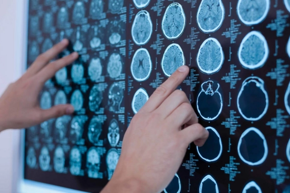 Simple habit helped reduce stroke risk