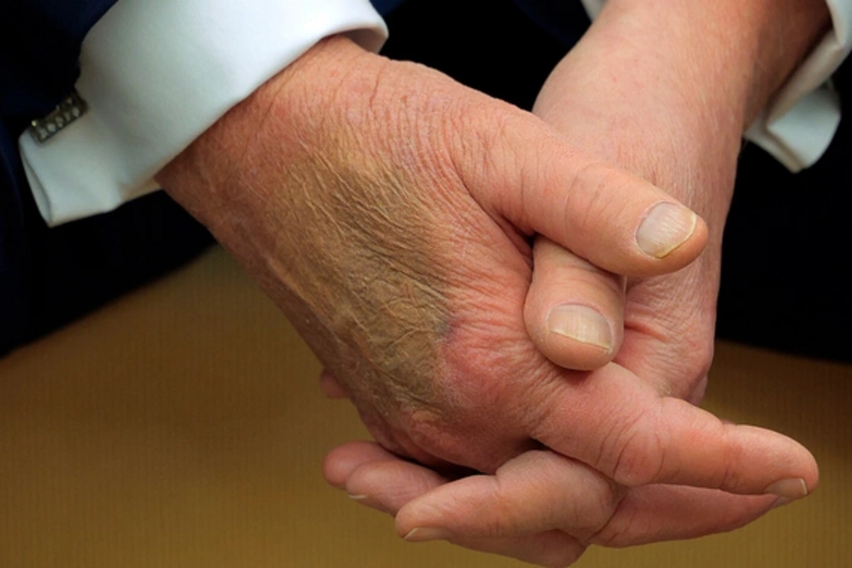 A strange bruise was noticed again on Trumps hand