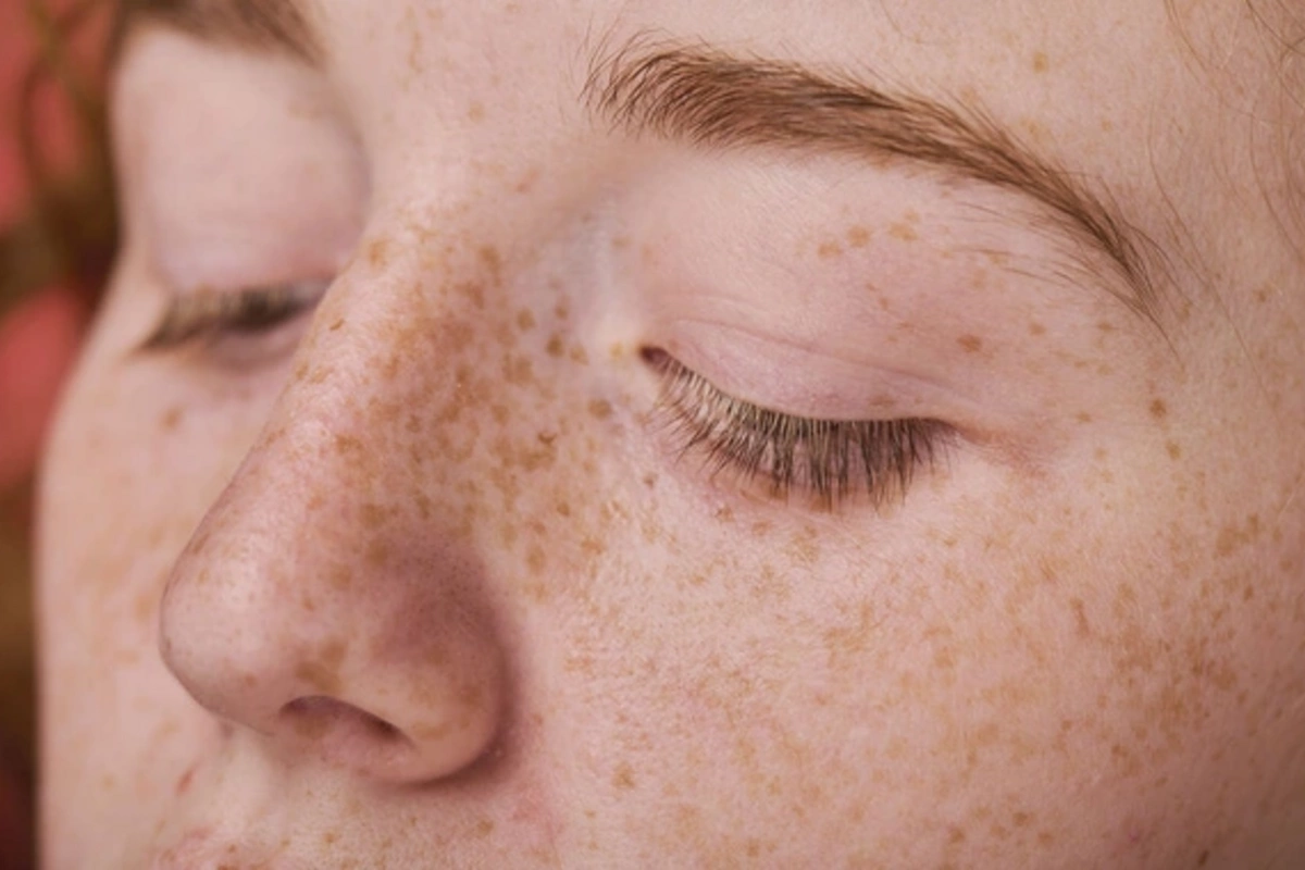 Doctor explained when freckles are a warning sign, not just a skin feature
