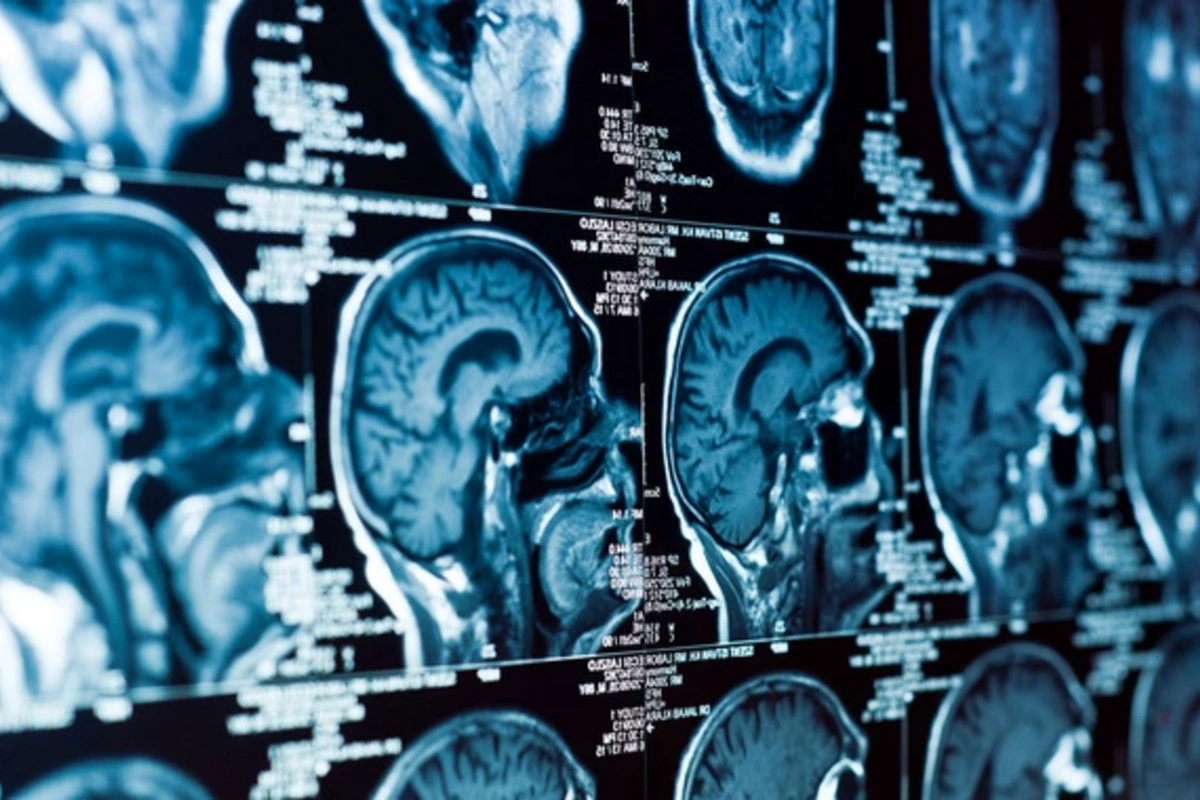 Обнаружен неожиданный фактор, провоцирующий деменцию в мозге