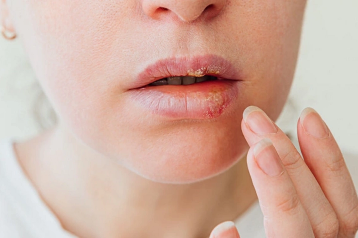 Ученые раскрыли секрет заразности вируса герпеса