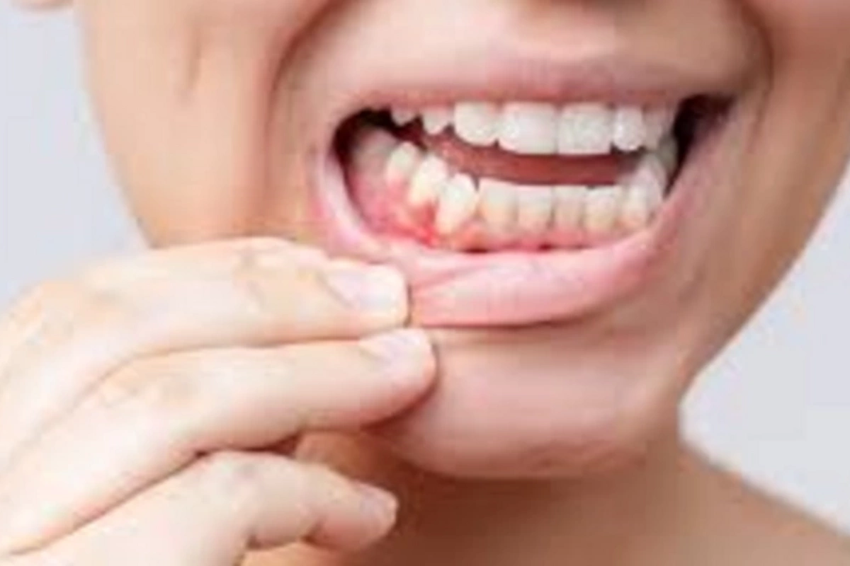 A surprising link discovered between gums and heart diseases
