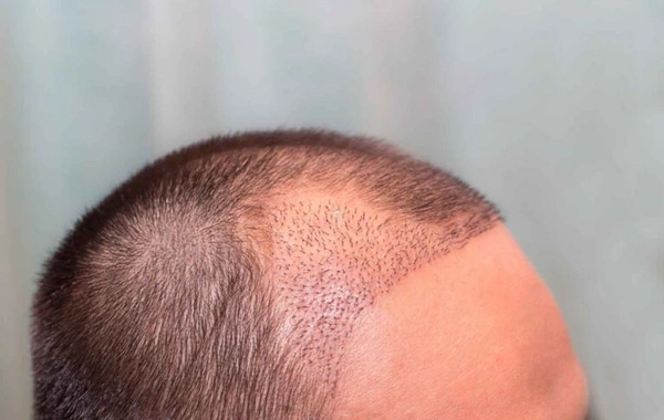 Hidden dangers of hair transplantation: who should avoid the procedure## Formatting note: Ive maintained the original text structure while translating from Russian to English as requested.
