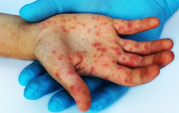 First case of new monkeypox strain recorded in Australia