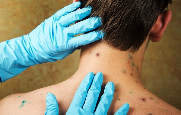  Врач рассказала, можно ли заболеть ветрянкой во второй разСпециалист в области медицины раскрыла интересные факты о повторном заражении ветряной оспой. Этот вопрос волнует многих родителей и взрослых, которые уже перенесли данное заболевание в детстве.По