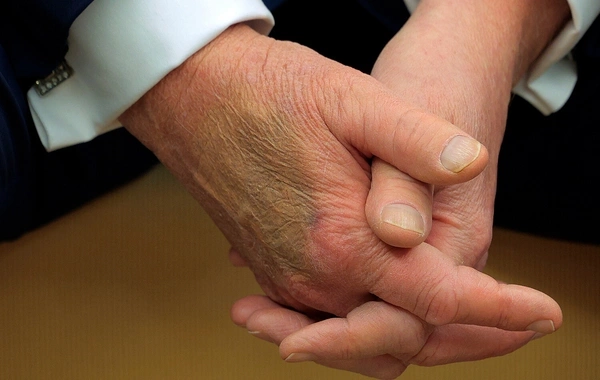 A strange bruise was noticed again on Trumps hand