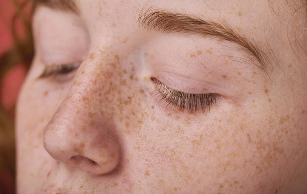 Doctor explained when freckles are a warning sign, not just a skin feature