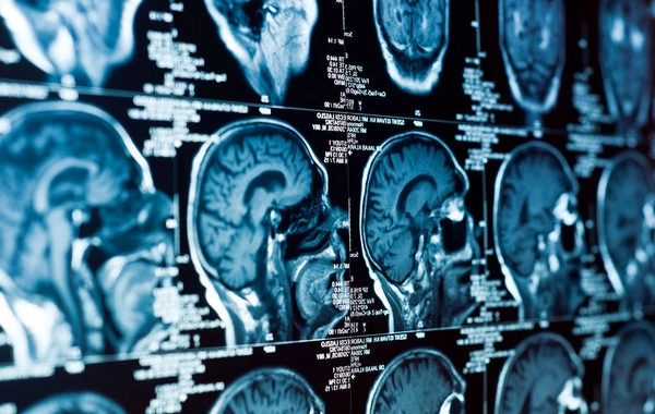 Обнаружен неожиданный фактор, провоцирующий деменцию в мозге