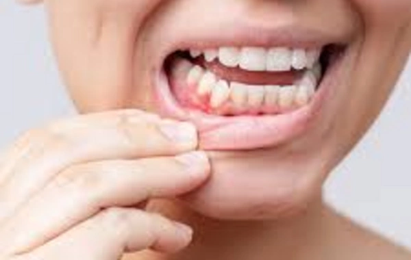 A surprising link discovered between gums and heart diseases